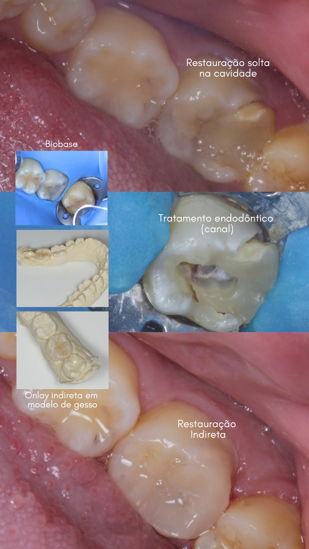 Tratamento de Canal (Endodontia)