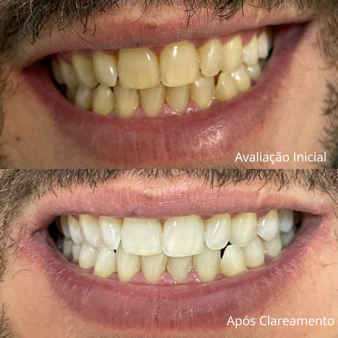 Clareamento Dental