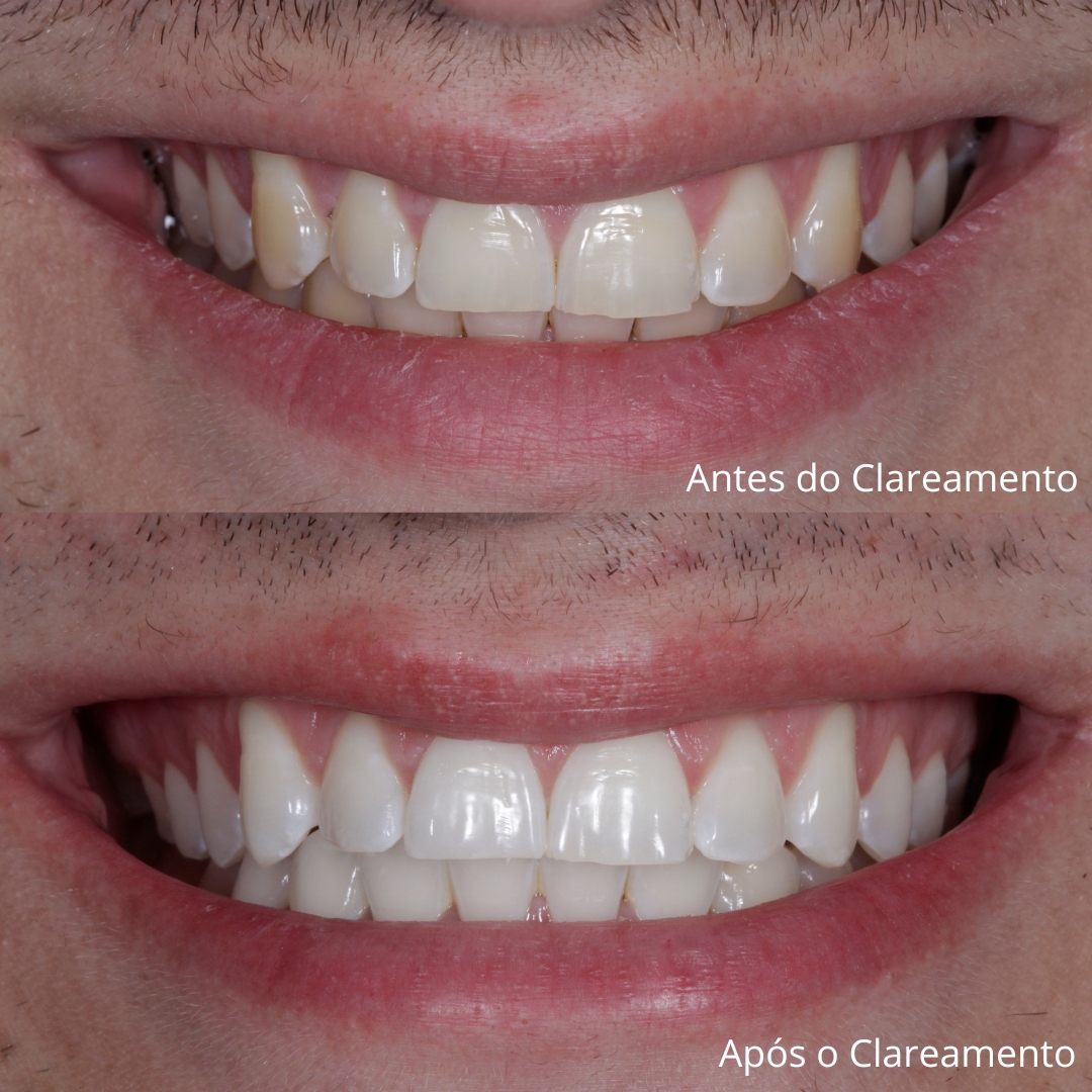 Clareamento Dental
